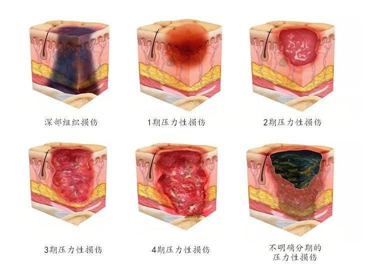 压疮分期最新解读，小伤口背后的暖心故事